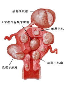 子宫肌瘤病理