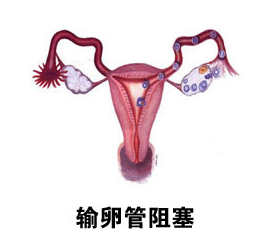 输卵管炎诱因